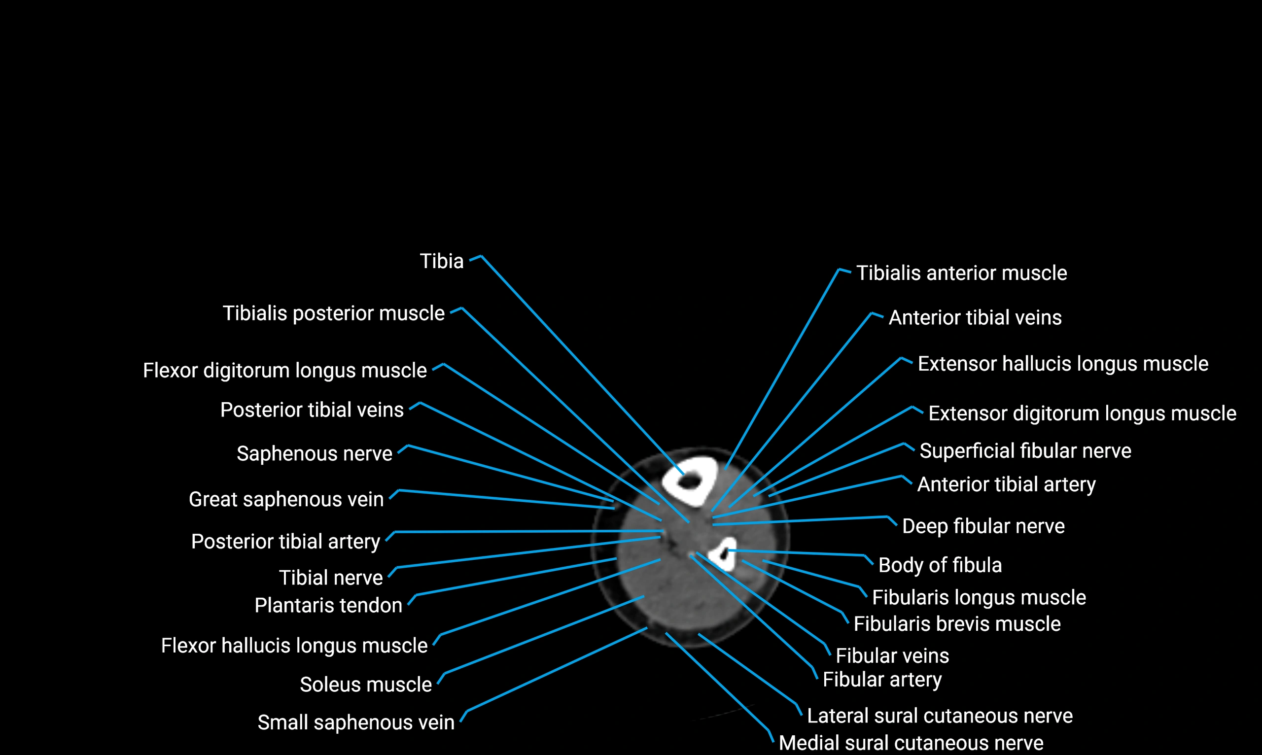 CT lower limb axial cross sectional anatomy labelled image 134 (2).webp